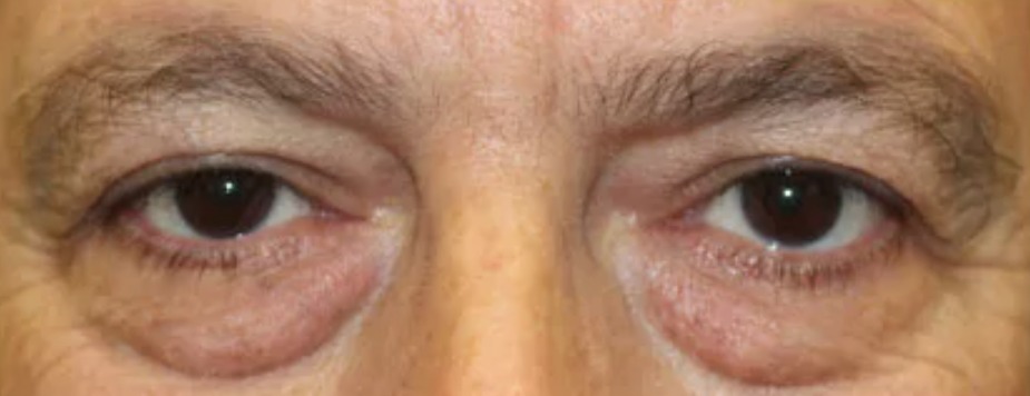 Before Eyes - Front View